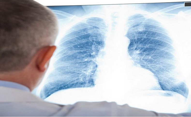 'Dünyada yılda 1,6 milyon kişi akciğer kanserinden ölüyor'