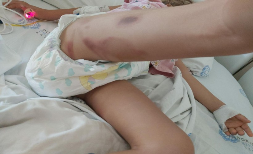 Apandisit ameliyatında skandal! 3 yaşındaki Yaren ameliyattan yanık izleriyle çıktı!