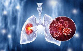 Her yıl 41 bin kişi Akciğer kanserine yakalanıyor!