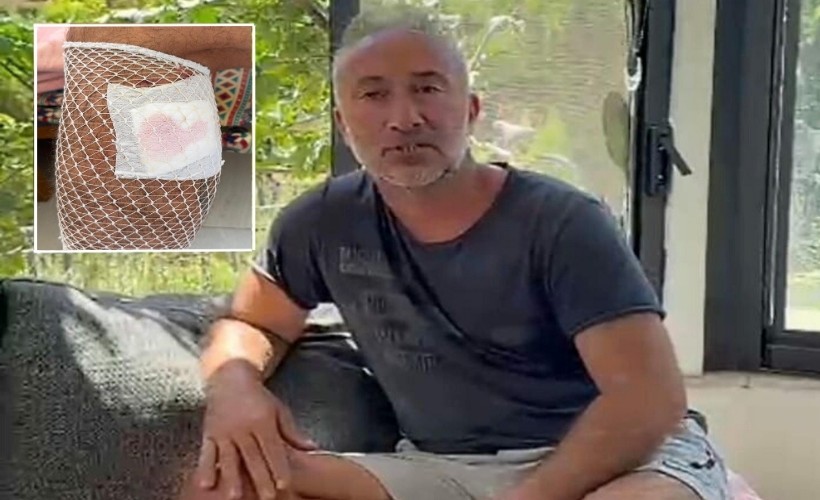 Yürüyüş yaparken köpek saldırısında yaralandı