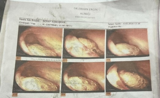 Ameliyatta gazlı bez unutulduğu iddiasıyla 2 doktor hakkında dava
