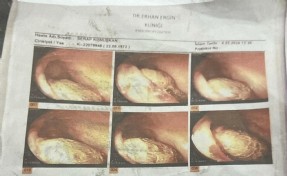 Ameliyatta gazlı bez unutulduğu iddiasıyla 2 doktor hakkında dava