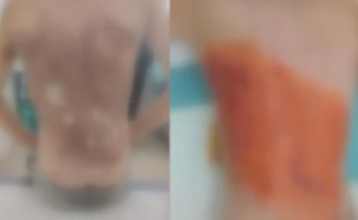 Dehşete düşüren akran zorbalığı! 12 yaşındaki çocuğa kolonya döküp ateşe verdiler