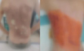 Dehşete düşüren akran zorbalığı! 12 yaşındaki çocuğa kolonya döküp ateşe verdiler