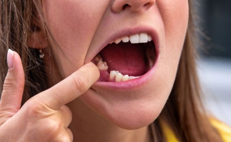 Corona virüs ani ve acısız diş kaybına neden olabilir