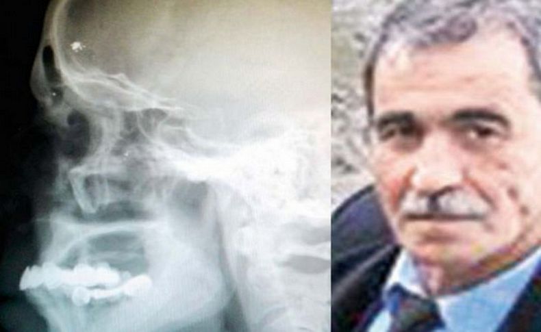 Kafasında 40 yıl mermi ile yaşadı!